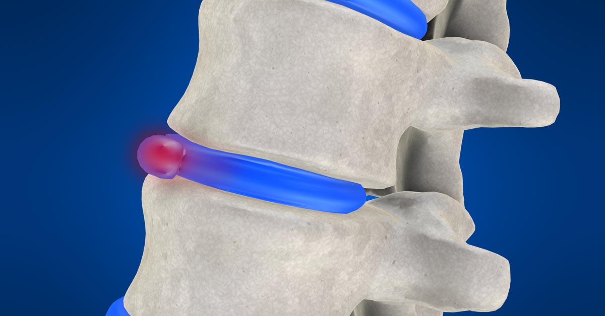 Naperville, IL non-surgical disc herniation treatment